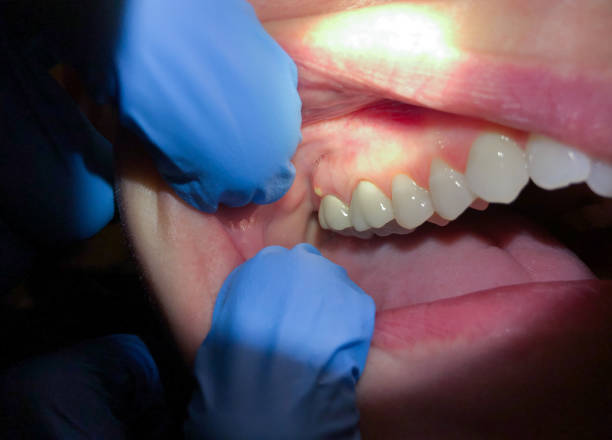 Best Emergency Dental Extractions in Cedar Crest, MA